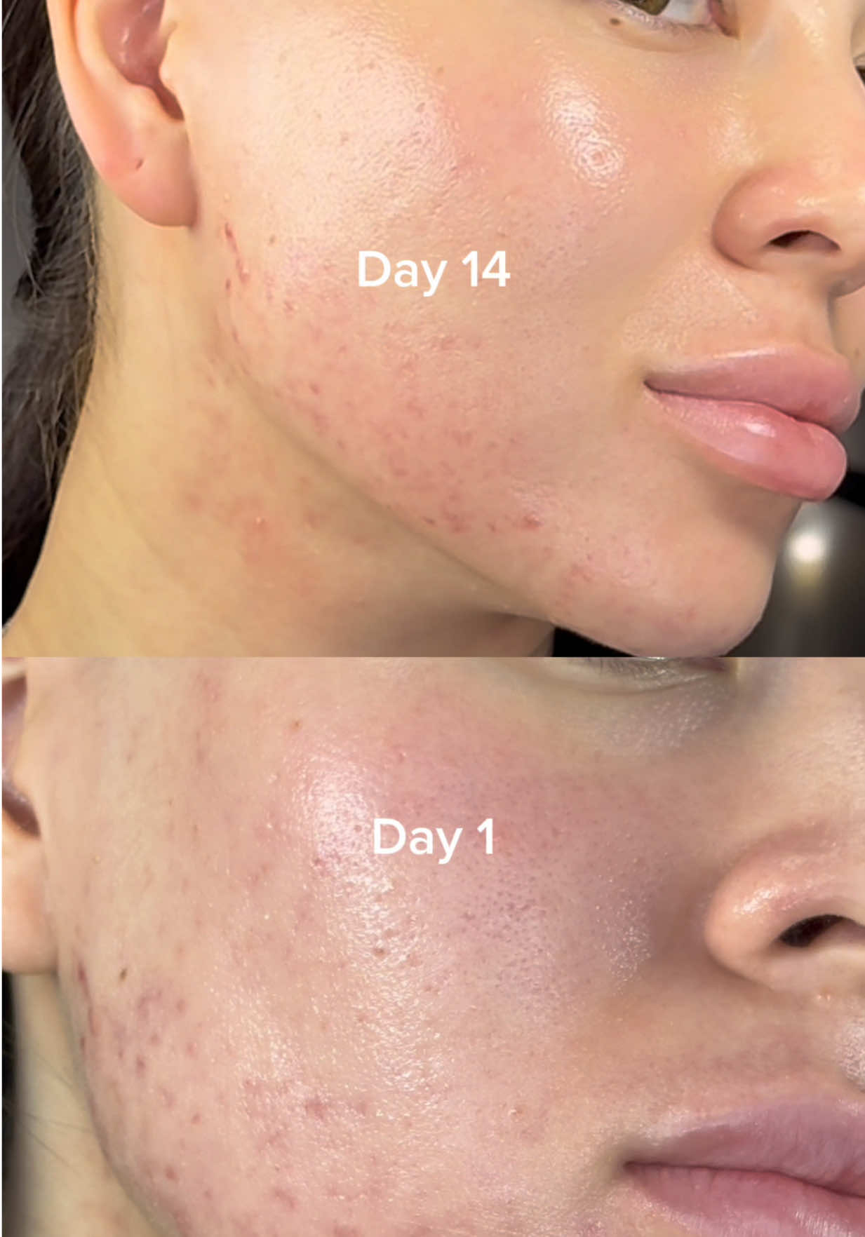 2-week glow-up with TOSOWOONG Arbutin 7% + Tranexamic Acid 4% Cream ✨ Dark spots faded by 30%, skin looks brighter and more even. Powered by 7% arbutin + 4% tranexamic acid. #tosowoong #arbutincream #tranexamicacid #txa #tranexamicacidcream #brighteningskincare #darkspotcorrector #arbutin7tranexamicacid4cream #AmazonDeals 