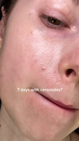 7 days with ceramides??  Skintific 5x Ceramide Barrier Moisturizer 💧🩵 #skintific #moisturizer #acne #skinbarrier #skincaretips #skincare 