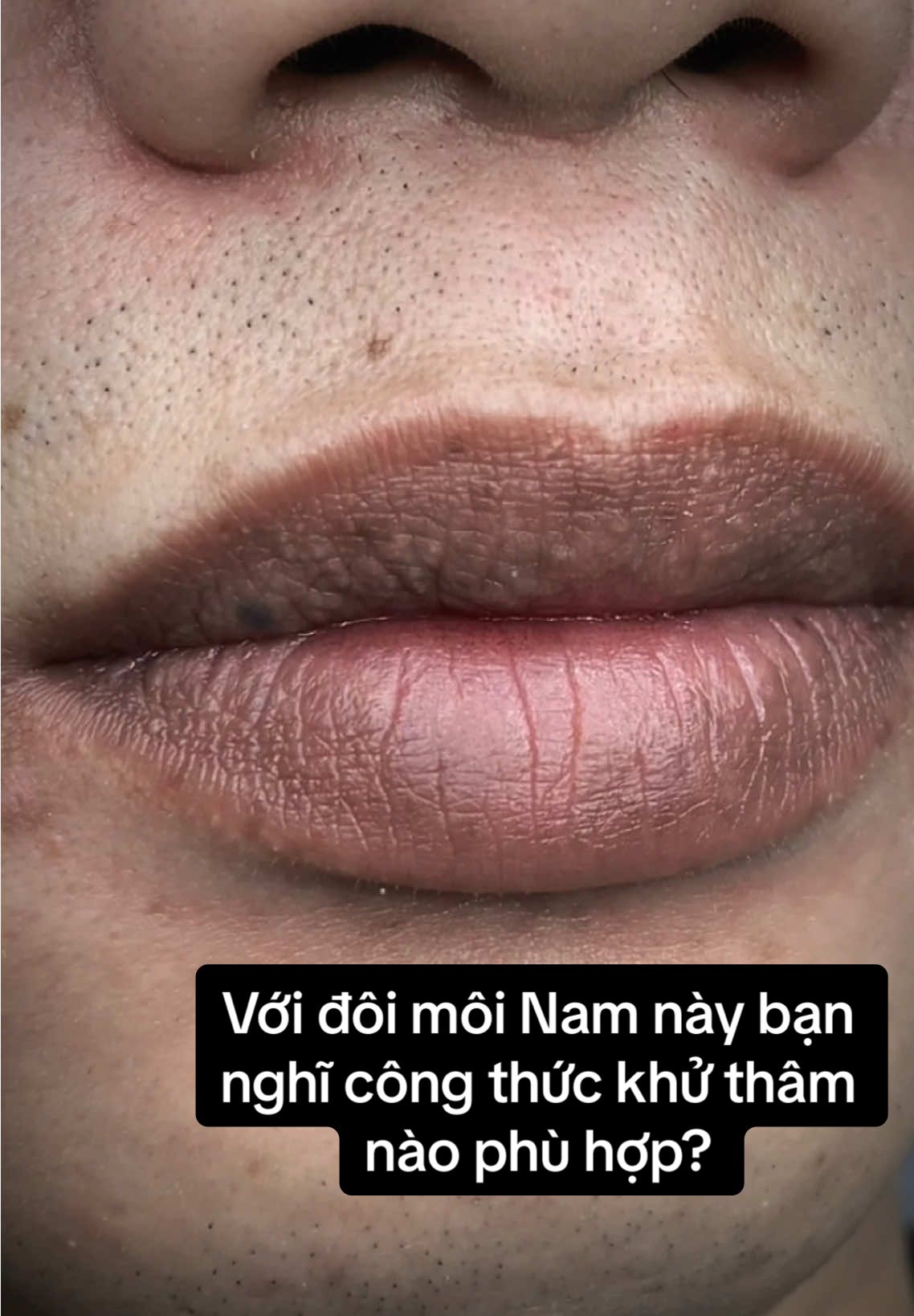 Với đôi môi Nam này bạn nghĩ công thức khử thâm nào phù hợp? Môi thâm nặng, chai bì, nhiều sắc tố, nhiều hạt fordyces.. #lamdep #xuhuong #trending #viral #khuthammoinam #phunmoi #khuthammoi #phunmoitebaogoc #lips #phunxamthammy #phunmoinhatrang #khuthammoitunhien  #phunxamthammychuyennghiep #pmu  #moidep #phunxamthammynhatrang #khuthammoinhatrang #phunmoitunhien #phunmoidep #lipblush #TikTokAwardsVN #LearnOnTikTok  