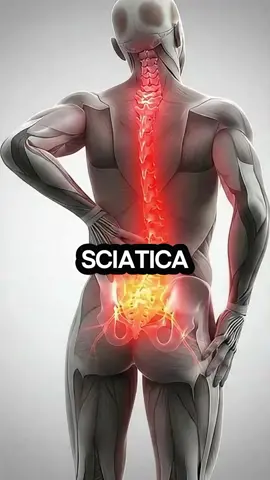 Warning signs of Sciatica 💀  #sciaticarelief #sciaticapain #sciatica #healthtips #unitedstates 