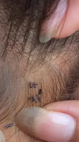 😱😱😱#omg #lice #liceremoval 