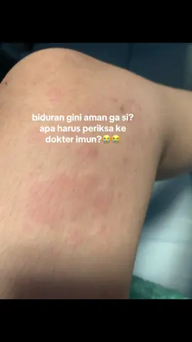 capeee bangett tiap hari muncull😭😭 mana posisi lagi kerja 😭🥺#biduren #biduran #biduranmenyiksa #fyp 