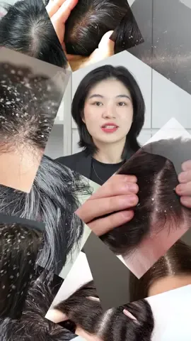 Gàu ngứa… Gội đầu đúng cách sẽ mang lại hiệu quả cao hơn. #antisol #ezema50 #trigau #trinamdadau #icarepharma 