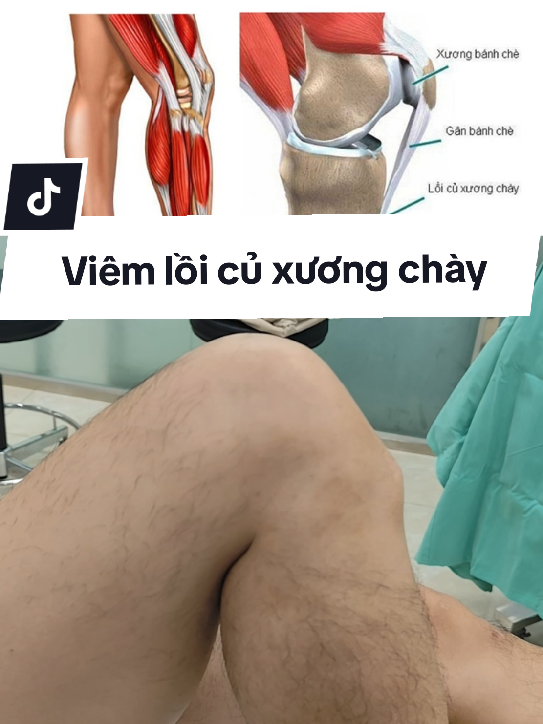Phẫu thuật điều trị viêm lồi củ xương chày hay còn gọi là bệnh Osgood Schlatter. Bệnh thường gặp ở trẻ em khi gân xương gắn với nhau chưa tốt và ở các be trai hoạt động nhiều cường độ cao làm cho phần bám của gân bánh chè vào xương chày bị viêm nhổ lên 1 phần. Bệnh thường tự khỏi sau 18 tuổi, một số đau kéo dài sau 18 tuổi sẽ cần can thiệp phẫu thuật. #songkhoemoingay #viemloicuxuongchay #viemganbanhche #osgoodschlatters #bshavietduc 