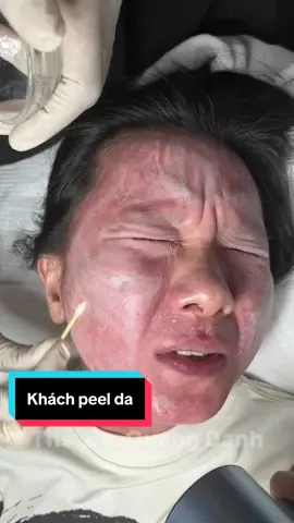 đau nhưng chắc chắn đẹp 🤩 #bsdl #xh #fyp #peel