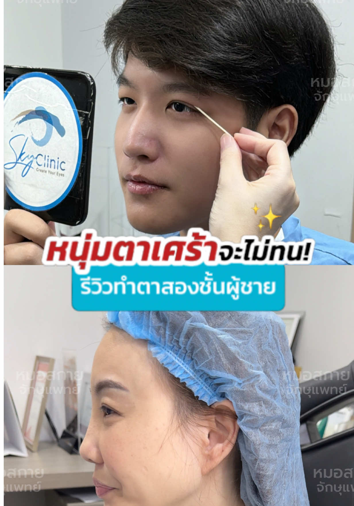 หนุ่มตาเศร้า จะไม่ทน❗️ #รีวิวตาสองชั้น #หมอสกาย #จักษุแพทย์ #หมอตา #ศัลยกรรมตา #skyclinic #สกายคลินิก 