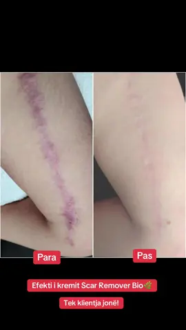 Faleminderit për besimin!🤍 Thuaju lamtumirë shenjave! ✨ Scar Remover Bio ndihmon lëkurën të rigjenerohet natyrshëm, për një fytyrë dhe lëkurë të pastër dhe të lëmuar. #fyp #blejonline #kosovatiktok #porositonline📥 #blejsigurt 