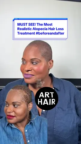 Art Hair at The Scalp Shop. Yes, #scalpmicropigmentation is advancing 🤌 Here’s how it went down: Our client-turned friend Rachel had lost her hairline and edges as well as substantial thinning in her crown. Once cut down, her hair showed an interesting pattern of small clumps throughout. With a mission to create the most realistic replication of her hair, we chose to jump right in to re-create those tiny groupings of hair. She was excited for us to match the clumps so that her hairline wouldn’t be follicle-style dots or masculine looking. (🙅🏾‍♀️No edge up for her!)  Here are the results of her ART HAIR by The Scalp Shop 🎨 Our innovative Scalp Micropigmentation treatment adds dimension, is long-lasting, won’t wash off, and requires no surgery or down time. What do you think of her #beforeandafter hair transformation? Let us know in the comments and follow @thescalpshop for more boundary-pushing hairloss solutions🙏😊❤️ 📲Book your complimentary consultation today at www.thescalpshop.com #Arthairsmp #arthair #thescalpshop #hairtransformation #hairloss #hairlossspecialist #alopecia #hairlosssolution #alopeciatreatment #hairtok 