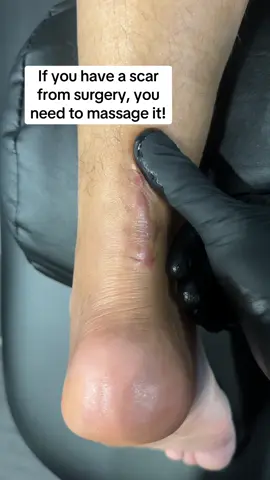 Scars from surgery can leave behind excessive tension, aches & pain which limit your ability to move optimally. Scar tissue massage helps mobilize the scar and relieve adhesions! #surgery #physiotherapy #physio  #scartissue  #achilles #physicaltherapy #rehabilitation 