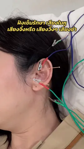 ฝังเข็มรักษาอาการเสียงในหู แนะนำทำต่อเนื่อง 3-5 ครั้งขึ้นไปนะคะ  #ฝังเข็ม #ฝังเข็มรักษาโรค #เสียงดังในหู #เสียงในหู #เสียงจิ้งหรีดในหู #หูอื้อ #แพทย์แผนจีน #ฟาจินคลินิก 