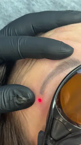 #picolaser #lasertattooremoval #видаленнятатуажукиів #permanentmakeupremoval #татуажбрів #permanenteyebrows #видаленняперманенту #лазертатукиїв #permanentmakeup 