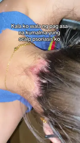 Scalp psoriasis and Hairfall from my hyperthyroidism 🤝 Gugo Shampoo😄 #gugoshampoo #scalppsoriasis #hairfall #hyperthyroidism #creatorsearchinsights 