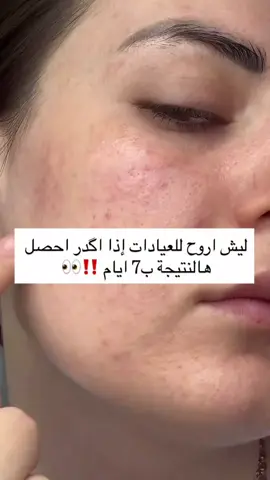 سيروم انوا الأحمر – بطل التهدئة والترطيب بتركيبة غنية بـ %70 من خلاصة الكركديه (Heartleaf)، يساعد على تهدئة التهيج، تقليل الالتهاب، وترطيب البشرة بعمق. مناسب للبشرة الحساسة والمتعبة، ويضيف نضارة طبيعية من أول استخدام 🌿🌸 #عناية_بالبشرة #tiktok #video #مشاهير_تيك_توك #اكسسسسسسسسسسسسسبلوررررررررر #ضيفوني #أنوا 