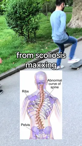 how I avoided #scoliosis #chad #lookism 