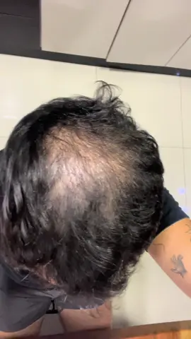 #tratamentocapilar #dutasterida #minoxidil #adforte #calvicemasculina 4 mês de tratamento 