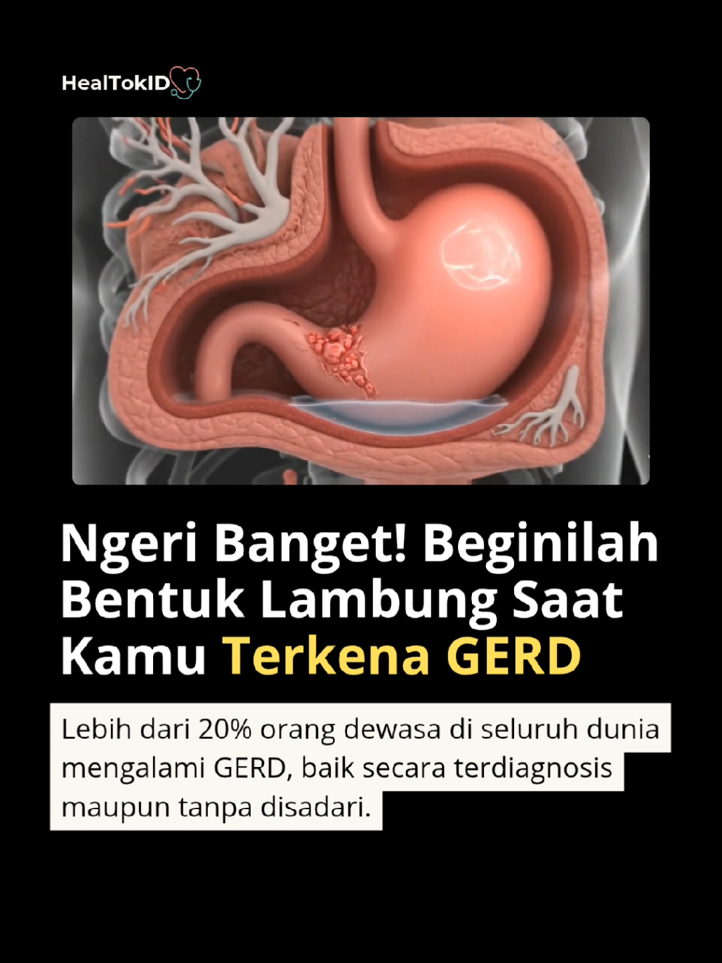 ⚠️GERD bukan sekadar sakit maag biasa. Lebih dari 20% orang dewasa di dunia mengalami GERD, dan banyak yang tidak menyadarinya. Gejalanya bisa muncul, seperti dada terasa panas, mual, sering sendawa, atau rasa asam di mulut. Kalau dibiarkan, GERD bisa merusak kerongkongan dan meningkatkan risiko kanker. Konsultasi Gratis 📞 0895 3616 27505 #fypシ゚ #gerd #lambung #kanker #sakit #usus #lambung  #kesehatanmasyarakat 