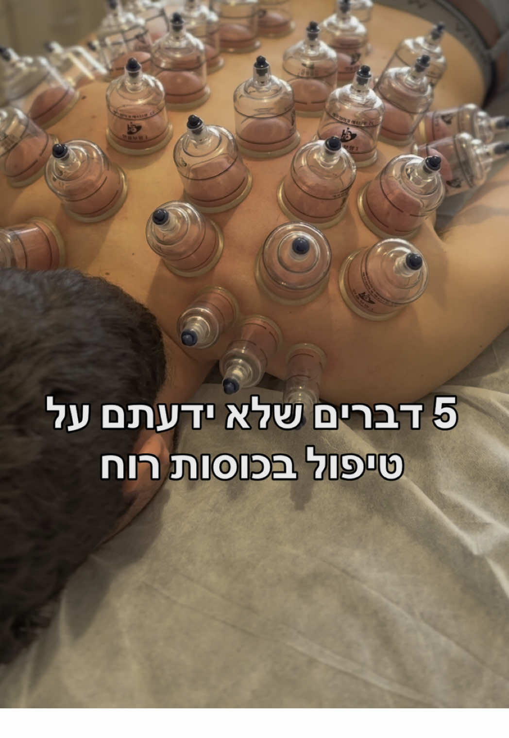 ‎1️⃣ הגברת זרימת דם מקומית ‎כוסות רוח יוצרות ואקום עדין שמעודד זרימת דם לאזור המטופל – זה מסייע בהזנת הרקמות, הפחתת דלקת ושחרור חסימות. ‎2️⃣ שיפור ניקוז לימפטי ‎הטכניקה מסייעת לפינוי רעלים ונוזלים עודפים דרך מערכת הלימפה – מה שתורם לתחושת הקלה כללית וחיזוק מערכת החיסון. ‎3️⃣ ויסות מערכת העצבים ‎כוסות רוח משפיעות גם על מערכת העצבים האוטונומית – מסייעות להרגעה, הפחתת סטרס ויציאה ממצב של “Flight or Fight”. ‎4️⃣ תמיכה במערכת הנשימה ‎במצבים של ליחה, שיעול או קושי נשימתי – אפשר לעבוד עם כוסות רוח לאורך הגב העליון ולעזור לפתוח את בית החזה. ‎5️⃣ שימוש מדויק בהתאמה אישית ‎כיום אנחנו לא “שואבים” רק כי יש כאב – אלא מתאימים את סוג הכוס, העוצמה והמיקום לפי אבחנה מדויקת ומצבו של המטופל. ‎📍בשורה התחתונה: ‎כוסות רוח הן כלי טיפולי רב-עוצמה, כשמשתמשים בו נכון. זה לא רק “שיטה עתיקה” – זו טכניקה מודרנית עם אפקטים קליניים מוכחים. ⸻ ‎👩🏻‍⚕️ רוצה להתייעץ אם כוסות רוח מתאימות לך? ‎מוזמן/ת להגיב כאן על הפוסט ׳כוסות רוח׳ ואחזור אליך לבדיקה. ‎#כוסות_רוח #רפואהמשלימה #שחרורמתחים #טיפולאינטגרטיבי #טיפולבכאבים 