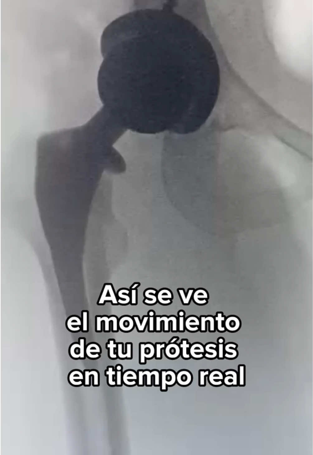 🦴 Así se ve el movimiento real de una prótesis de cadera en acción. 📹 Estas imágenes con rayos X muestran cómo se recupera la movilidad gracias a una cirugía bien realizada. 💬 Muchos pacientes llegan con años de dolor, creyendo que 