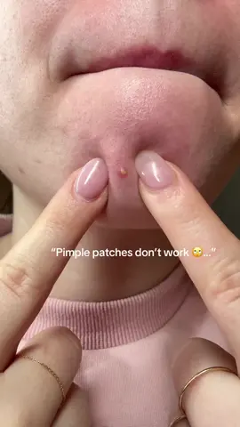 The best Acne Patches #rowmshi #acnepatch #acnepatchviral #rowmshiacnemicroneedle #microneedling #acnefighter #pimples #jerawat #acnejourney #acneproneskin