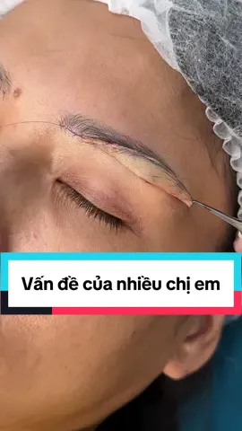 Vấn đề sụp mí do da chùng của rất nhiều chị em #nangcung #nangcungchanmayrutchi #nangcungchanmay #nangcungmay #xuhuong #ilovetiktok 