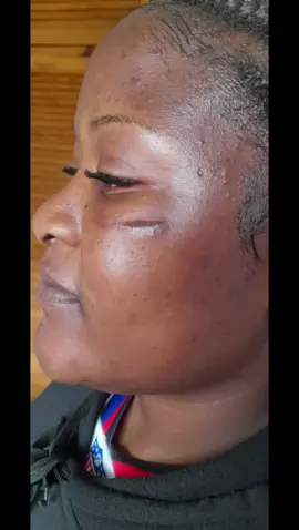 #scarremoval #oldscars #skinrejuvenation  #foryoupage #foryoupage❤️❤️ #fyp #fypシ #zedtiktok🇿🇲🇿🇲 #zambiantiktok🇿🇲 