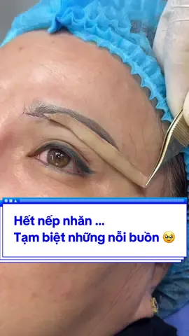 Hết nếp nhăn … Tạm biệt những nỗi buồn 🥹#Tuyết_Diamond #videoviralitiktok #xuhuong #Mí_form_tự_nhiên #Nâng_cung_chân_mày #Nâng_cung_chân_mày #khâu_rút_chỉ #