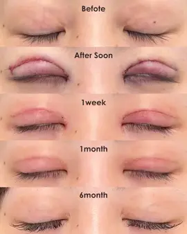 Cắt mí ổn định sau 6 tháng. Cắt mí đẹp tại Bắc Ninh 🎀#xuhuongtiktok #bacninh #catmi #catmidep #suami 