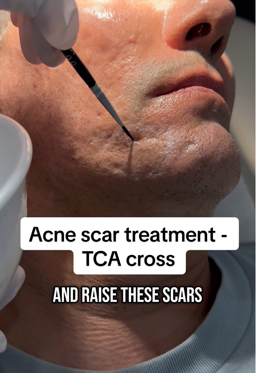 #acnescars#tca#tcacross#dermatology#co2laser#subcision#scar#scarrevision#confidence#filler#collagen#sculptra#radiesse 