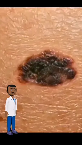 Yang mikir ini tahi lalat biasa, jangan salah deh, tonton video aku sampe habis!! #moellskincarebaby #sunscreenbaby