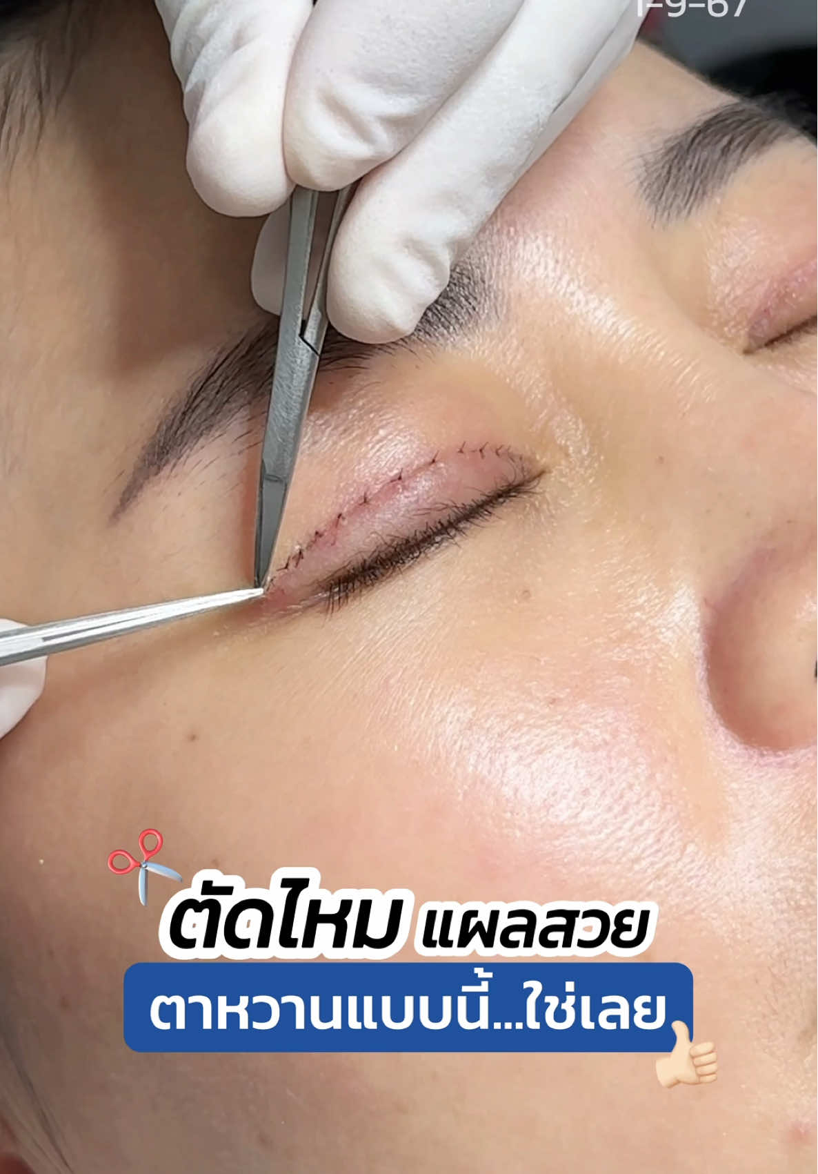 ตัดไหม ✂️ #ทำตาสองชั้น ตาหวานแบบนี้ใช่เลย ✨ #skyclinic #จักษุแพทย์ #ทำตาที่ไหนดี #หมอสกาย #สกายคลินิก #รีวิวตาสองชั้น 