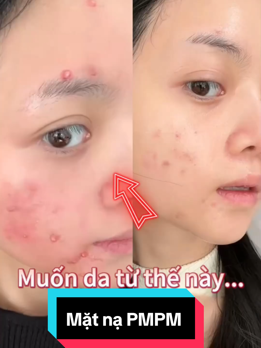 MẶT NẠ PMPM #xuhuong 
