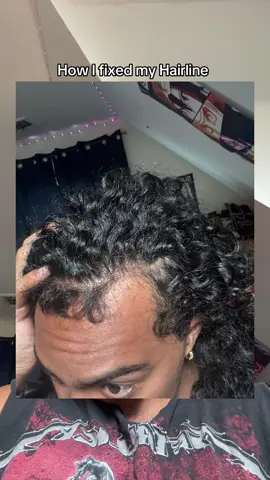 #hairline #hairloss #balding #recedinghairline #hairoil #fyp 