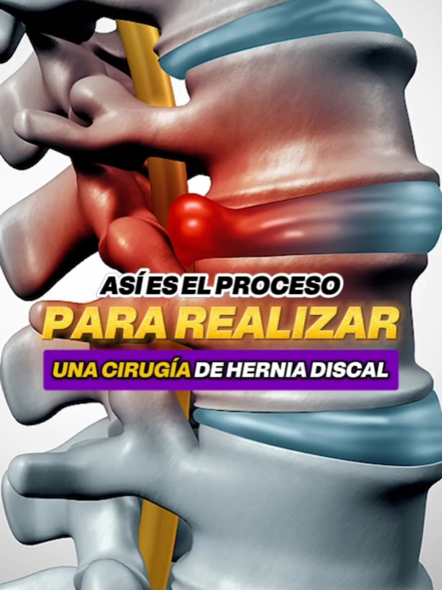 🩺💊 ASÍ es el PROCESO ☝️ para REALIZAR una CIRUGÍA de HERNIA DISCAL ⚕️😯  @doctorvic