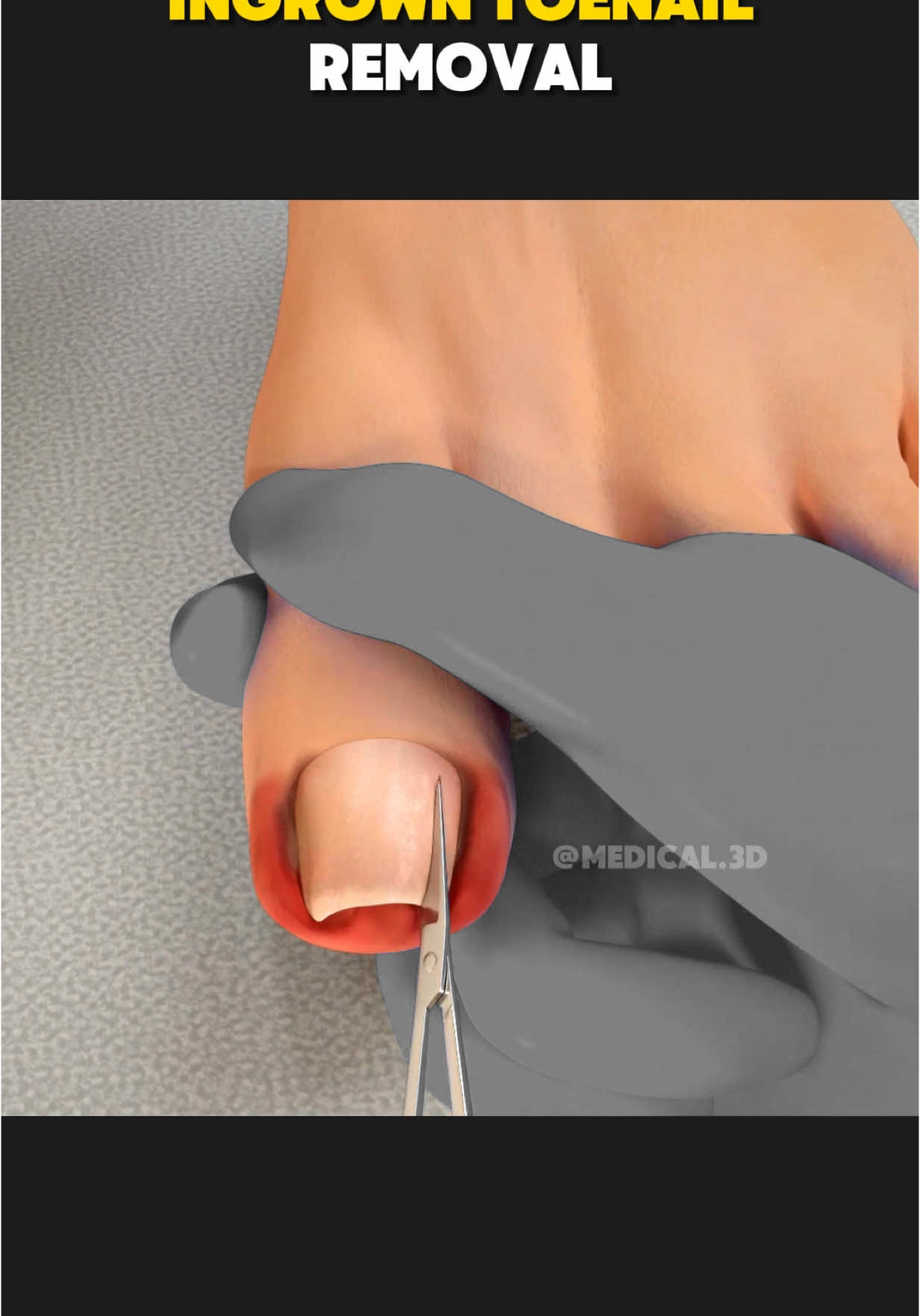 Ingrown Toenail Removal Surgery (3D Animation) #ingrowntoenail #ingrowntoenailremoval #ingrowntoenailsurgery #ingrowntoenailtreatment #toenailsurgery #ingrownnail😢😰 #ingrowntoenailremoved #medical3danimation  #3dmedicalanimation 
