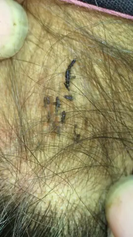 Remove lice #😱😱😱omg #😭😭😭 #liceremoval #🥶🥶🥶 #like 