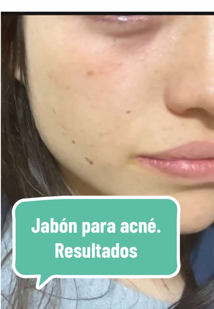 Esto se debe a que la turmalina tiene propiedades antibacterianas y antiinflamatorias, que reducen la inflamación y promueven una piel saludable. #fyp #foryoupage #jabondeturmalina #jabonacne #resultados #beauty #skincare #jabonfacial #turmalina #cuidadodelapiel 