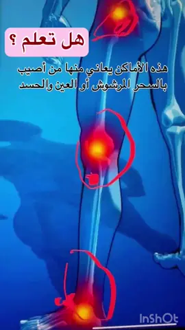 💥 الحجامة 💥 الحجامة النبوية هي علاج طبي تقليدي مستمد من السنة النبوية،  حيث يتم فيها استخدام أكواب خاصة على الجلد لإنشاء ضغط سلبي، بهدف تحفيز الدورة الدموية وتخفيف الألم وبعض الأمراض.  والحجامة هي من الطب النبوي ولها فوائد صحية متعددة، بما في ذلك علاج بعض الأمراض المتعلقة بالعين. الحديث: ( إن خير ما تداويتم به الحجامة والسعوط ) رواه مسلم. يدل على أن الحجامة دواء طيب،  إنها أحسن ما تداوى به الناس عند تغير الدم ووفرته وثورانه . يُوصى بالعلاج بالحجامة في أيام معينة، وحسب الحديث النبوي ،  أفضل أيام الحجامة هي 17 و19 و21 من كل شهر في السنة الهجرية،  والتي تتزامن عادة مع أيام الإثنين أو أيام الثلاثاء أو أيام الخميس. #fypシ #tiktokarab #اكسبلور #فوائد_الحجامة #صحتك #الحجامة #infoburst 