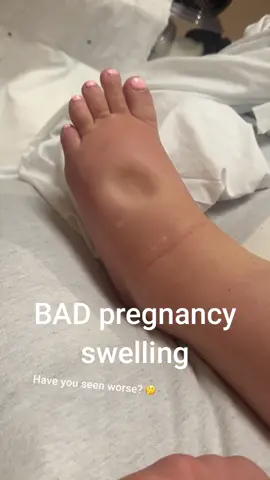 Swollen feet or free water cup??? #swollen #pregnant #pregnancy #preeclampsia #twins #twinpregnancy #girlmom #girldad #identicaltwingirls #funny #family #marriage #havefunwithlife #reelscomedy #fyp #reels less