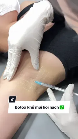 Botox khử mồ hôi,mùi hôi nách. Tặng video cho chị em nào cần nha❤️❤️#filler #botox #tiemfiiler #tiembotox #sohi #khumuihoinach #tiemnach 