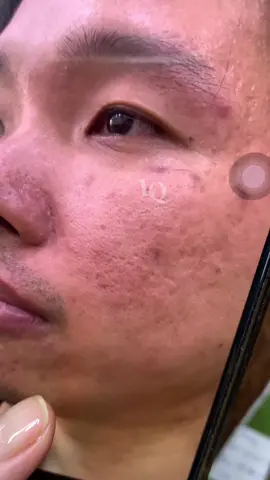 Cập nhật Da sẹo#chamsocdaseo#chamsocda#chamsocdamun#chamsocdanam#tanbinh#govap #Lequynh#Lqspa#hocnghespa  #chamsocda #lequynhspa #vienthammylqspa #nanmunbangtay #nanmunbangtambong#nanmunbangcay