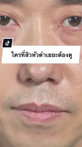 ใครที่สิวหัวดำเยอะต้องดูคลิปนี้ให้จบ #มาส์กดันสิวเสี้ยน #มาส์กเปปไทด์ #มาส์กเปปไทด์ตัวดัง #มาส์กจมูก #จัดการสิวเสี้ยน 