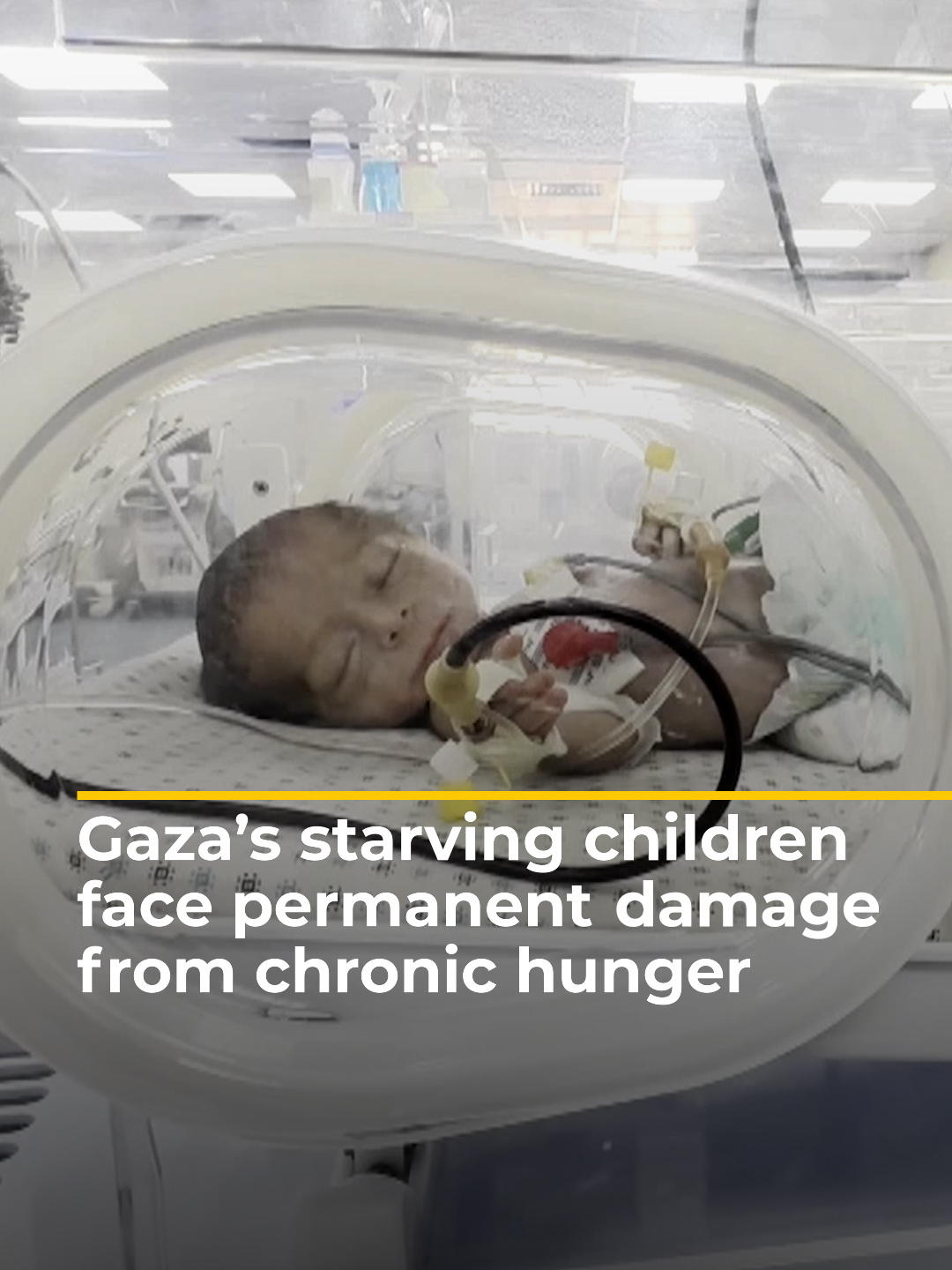 Doctors fear that even if aid reaches Gaza’s starving children, it may come too late to save them from irreversible harm. The #UN warns Israel has pushed #Gaza to the ‘brink of full-scale famine’, as Al Jazeera’s Ibrahim al-Khalili explains. #news