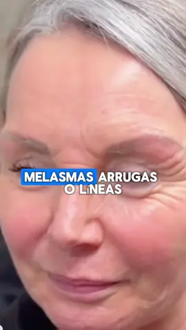 ✨👩🏻 Transforma tu rostro en esta creama 💖 #melasma #piel #pielperfecta #pielradiante #manchas #antiarrugas #belleza #fyp #parati #mujeres #tipsdebelleza 