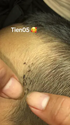 Remove lice #lice #omg 😘😘#liceromoval #❤️❤️❤️ #omg😰😰 