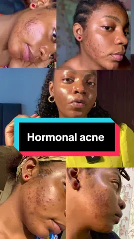 Products that would effectively help you get rid of hormonal acne  #skincare  #skintok #skincarereview  #hormonalacne #skin1004tonebrightening  #acne  #hyperpigmentation  #hyperpigmentationtreatment #hormoneimbalance 