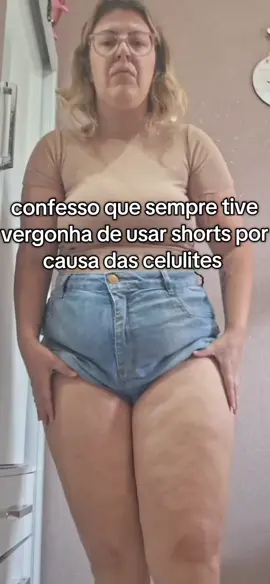dando adeus às crateras da perna 🙅‍♀️❌️🙏#brasil #transformação #celulites #lipedema #antesedepois 
