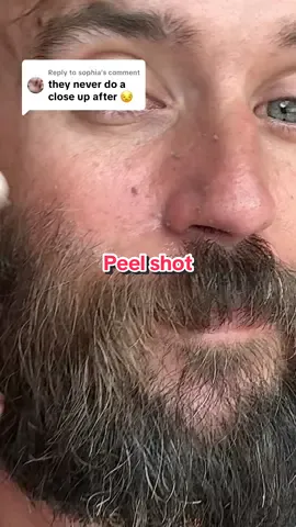 Replying to @sophia zoomed in the entire time & extra close up after! @Dr.Melaxin Global #drmelaxin #peelshot #peelshotampoule #blackheads #blackhead #exfoliation #skincare #koreanskincare #ttsbeautybesties #ttsdelightnow #Tiktokshopcreatorpicks #tiktokshoprestock #tiktokshopnewarrivals #tiktokshopbacktoschool #tiktokshopblackfriday #tiktokshopcybermonday 