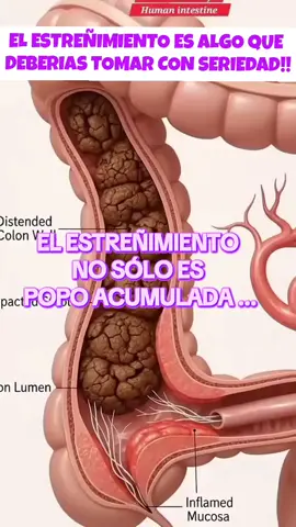 EL ESTREÑIMIENTO ES POPO ACUMULADA PERO TAMBIEN CONLLEVA A TENER  HINCHAZON ABDOMINAL GASES DISTENSION ABDOMINAL DIFICULTAD PARA EL VACIADO COMPLETO DOLORES Y COLICOS ESTOMACALES DESCONTROL DE VEJIGA HEMORROIDES FISIRAS ANALES... . . . . . . . . . . . . . . #estreñimiento #estreñimientocronico #gases #Detox #sigueme #desintoxicacion #teadetox #tea #natural #sobrepeso #estreñimiento #inflamacionabdominal #gordita #woman #GlowUp #peso #transformation #weithloss #fyp #Viral #desintoxicacion #caballos #boots #vaqueros #rancho  #recetas #consejos #intestino 