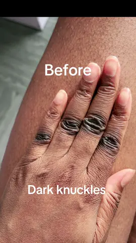 2.	Mary & May Tranexamic Acid + Glutathione Eye Cream 	•	Why: Although it’s labeled as an eye cream, it contains two powerful brightening agents. You can dab a small amount on dark knuckles to target stubborn discoloration. 	•	How to use: Use it as a spot treatment — just a tiny amount — 1–2 times daily @Mary&May Official  #marynmay #marynmaypopchallenge #eyecream #kbeauty #txa #tranexamicacid #glutathione #darkcircles #wrinkles 