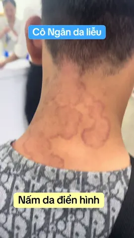 Tình trạng nấm da điển hình lan rộng như rừng nguyên sinh. Ai tiếp xúc rất dễ lây nhé. #congandalieu #viemda #nấmda